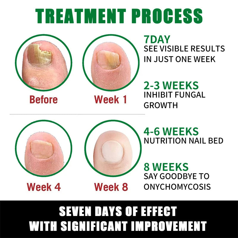 7 Days Nail Fungal Treatment Essence Oil